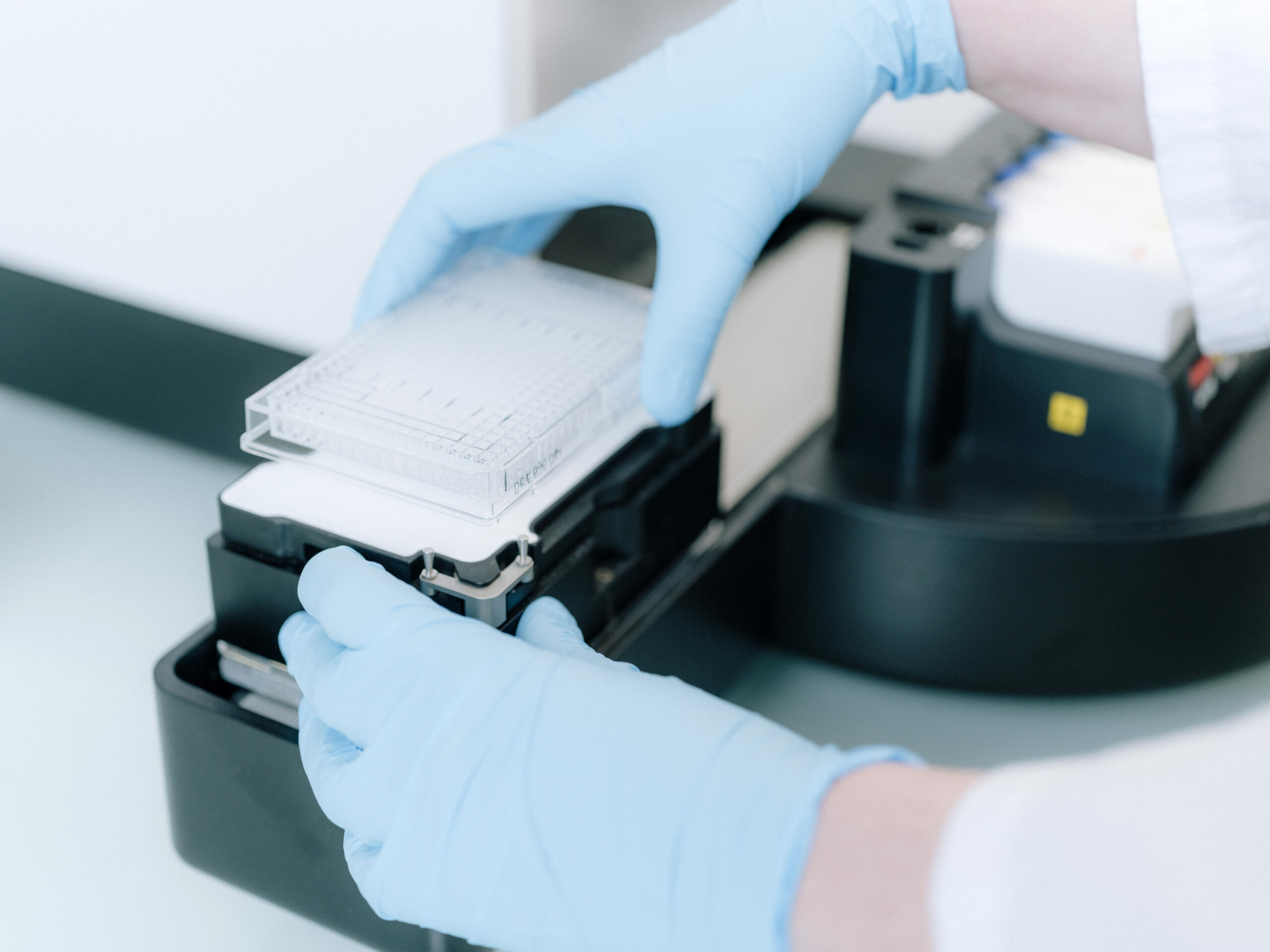 Sélection clonale de mutations de la voie RAS induite par le traitement des NMP