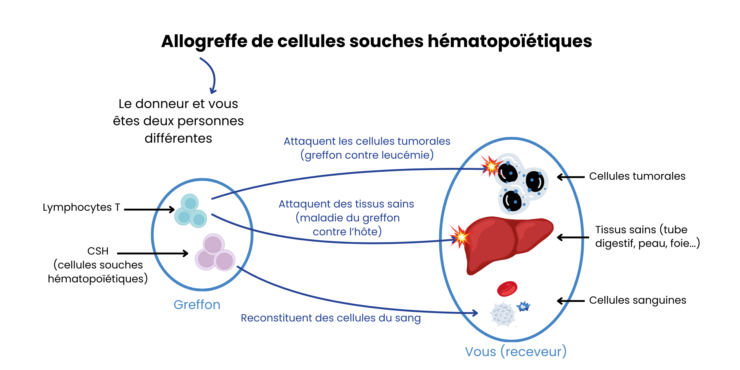 illustration allogreffe de cellules souches hématopoïétiques